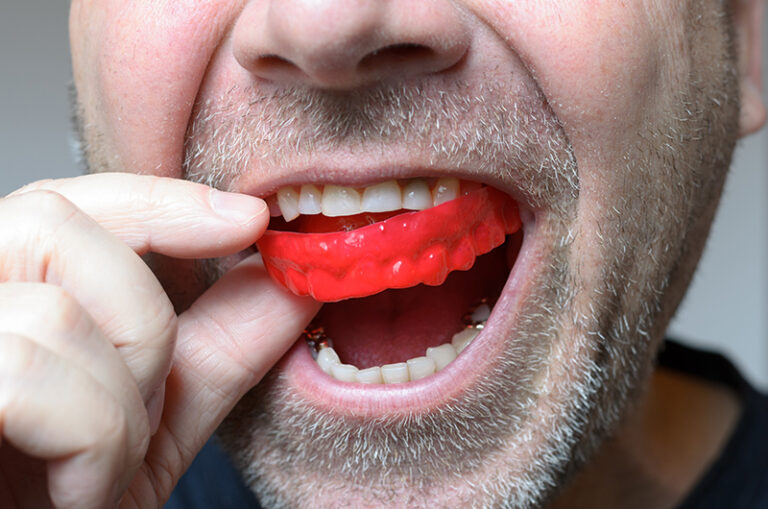 bruxism & mouth guards in se calgary