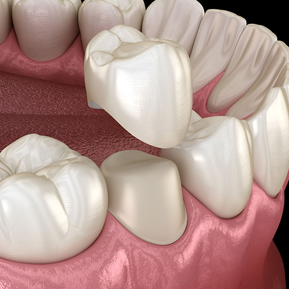 dental crowns and dental bridges in se calgary