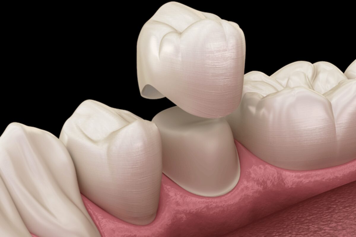 how crowns protect weakened or damaged teeth